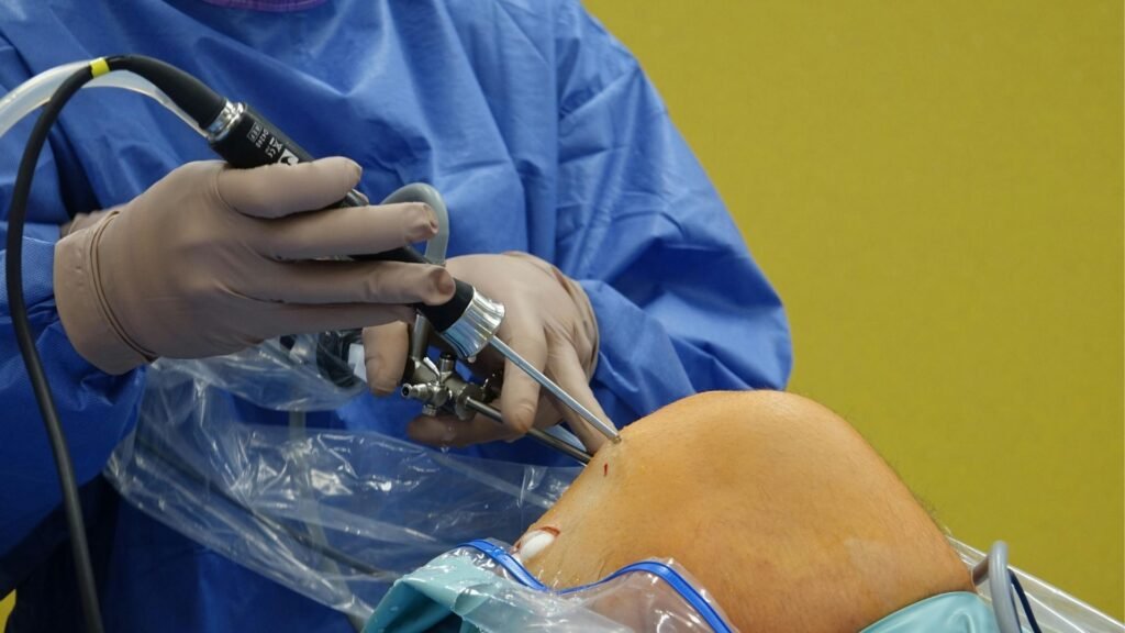 Arthroscopic ACL reconstruction with hamstring graft