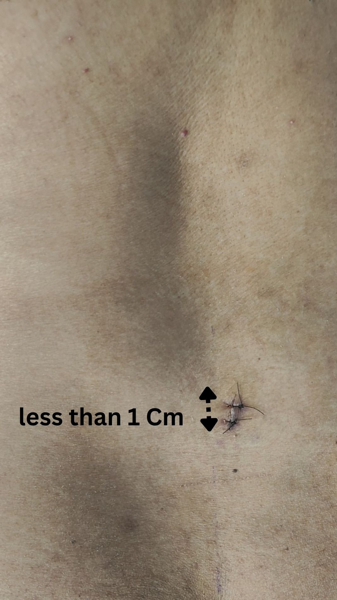 Endoscopic spine surgery incision