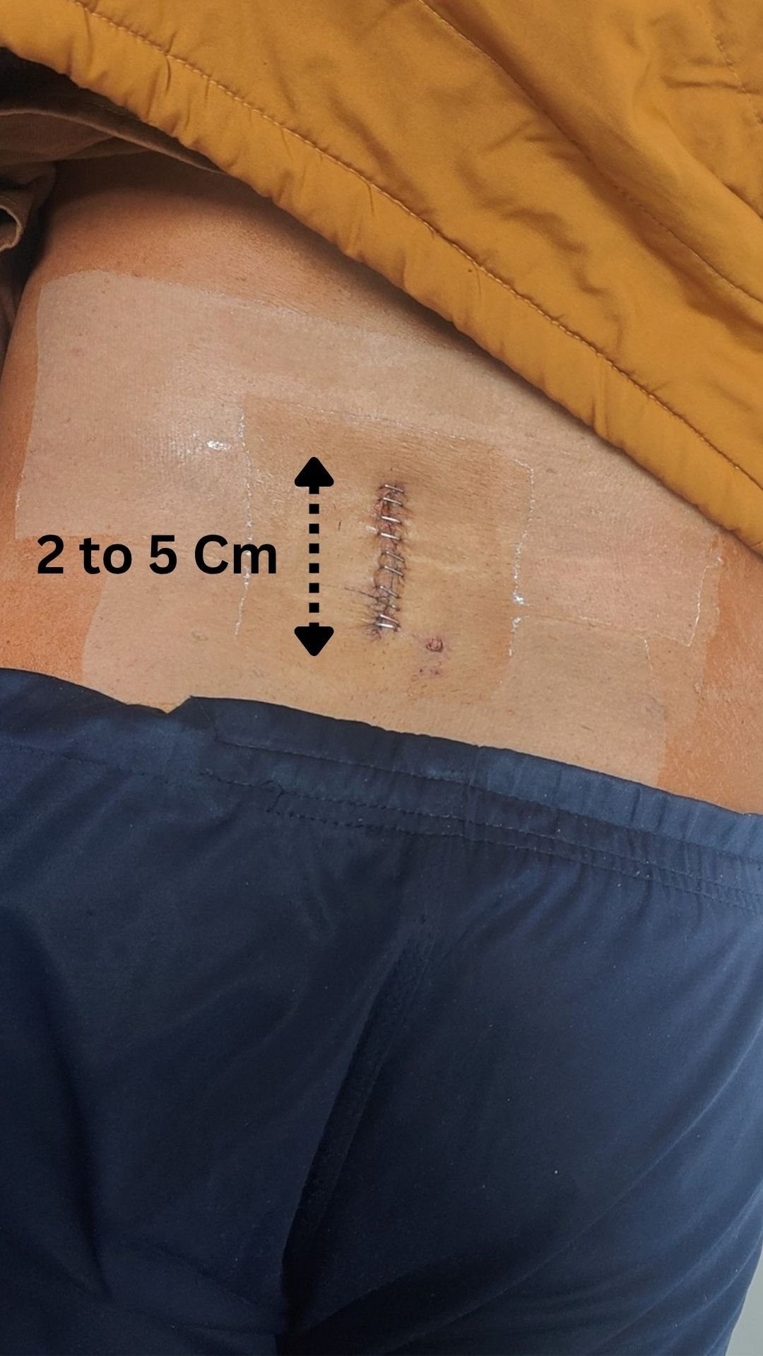 Microscopic spine surgery incision