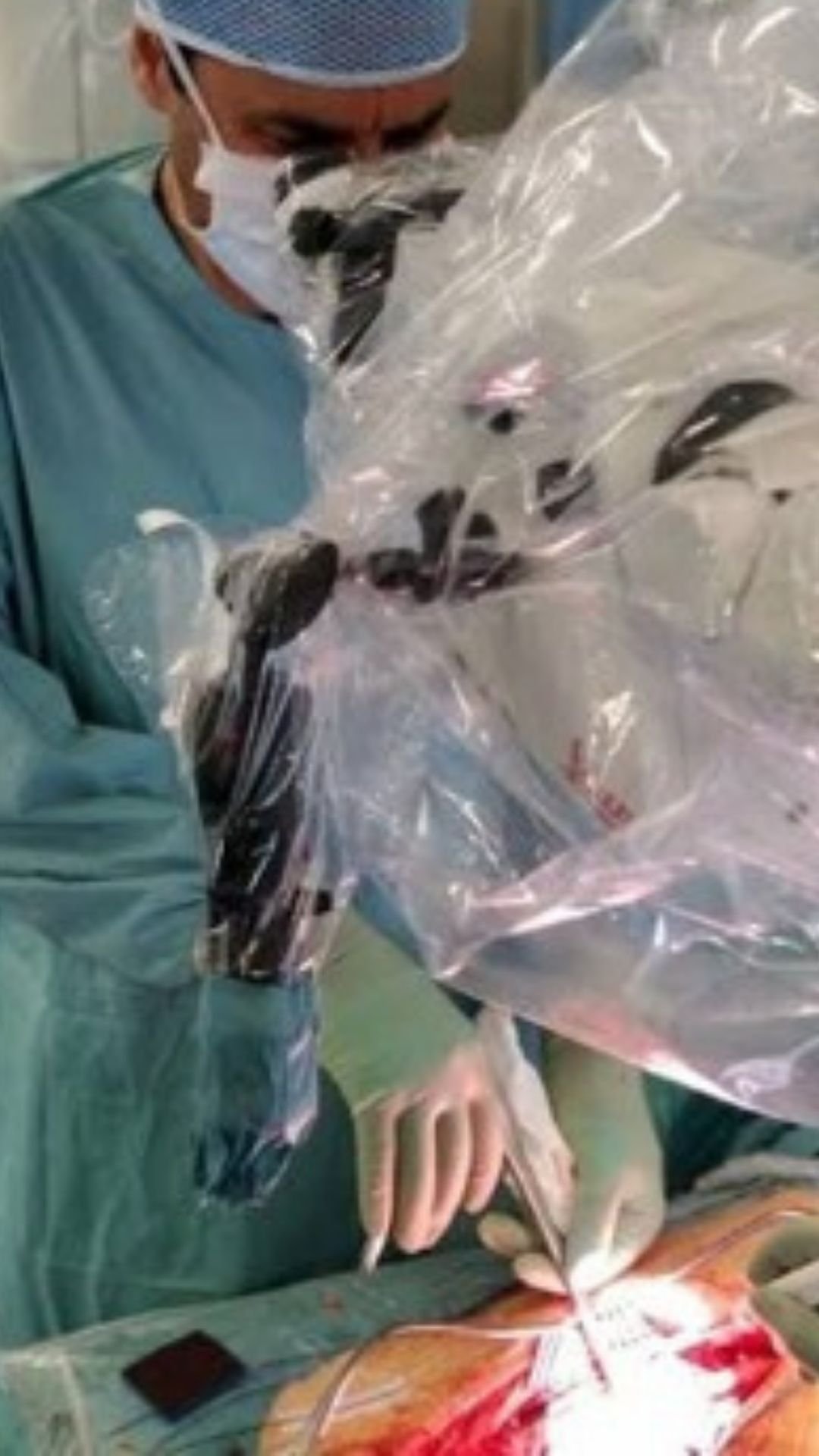 Microscopic spine surgery technique