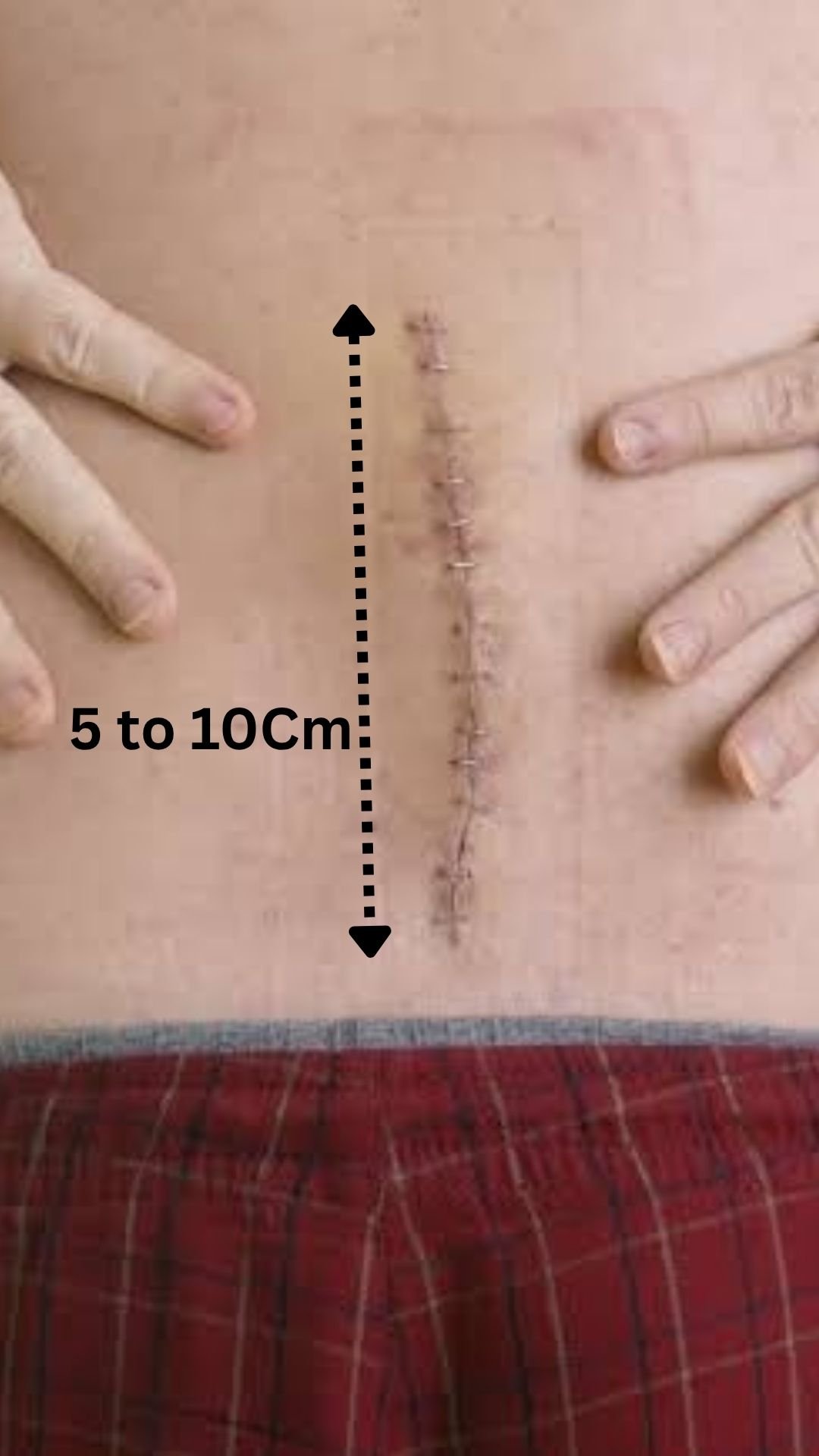 Open spine surgery incision