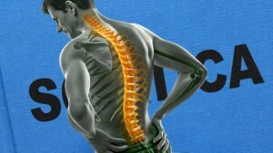 Sciatica and disc bulge