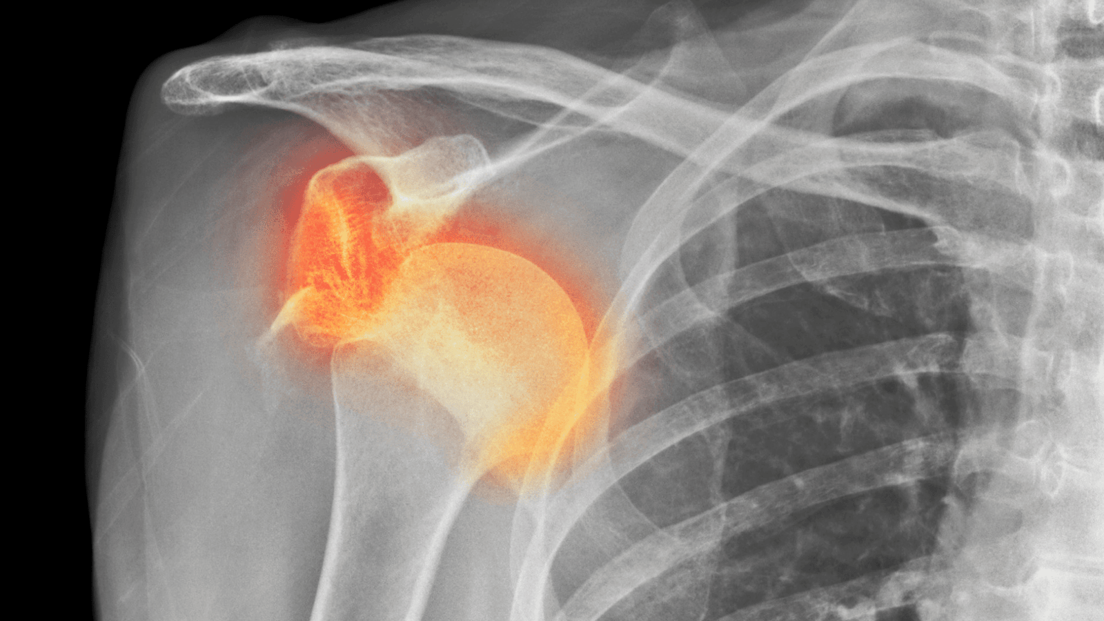 Recurrent shoulder dislocation