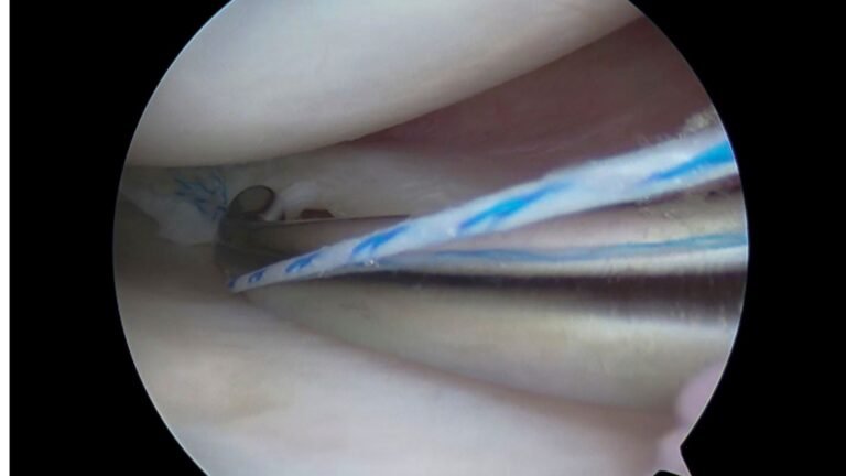 Arthroscopic meniscus repair