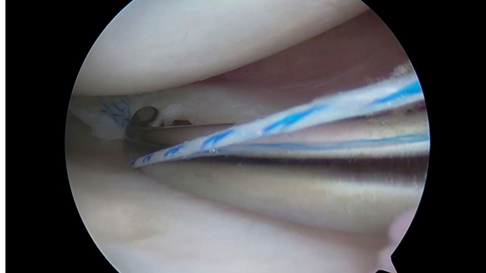 Arthroscopic meniscus repair