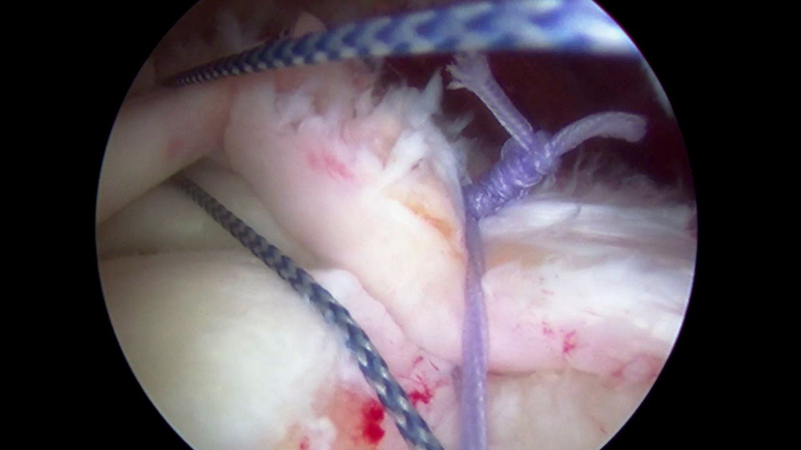 Arthroscopic rotator cuff repair