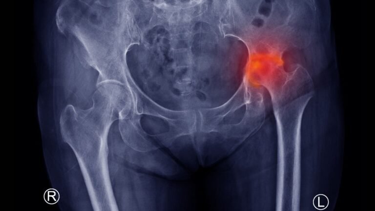 Avascular necrosis of hip