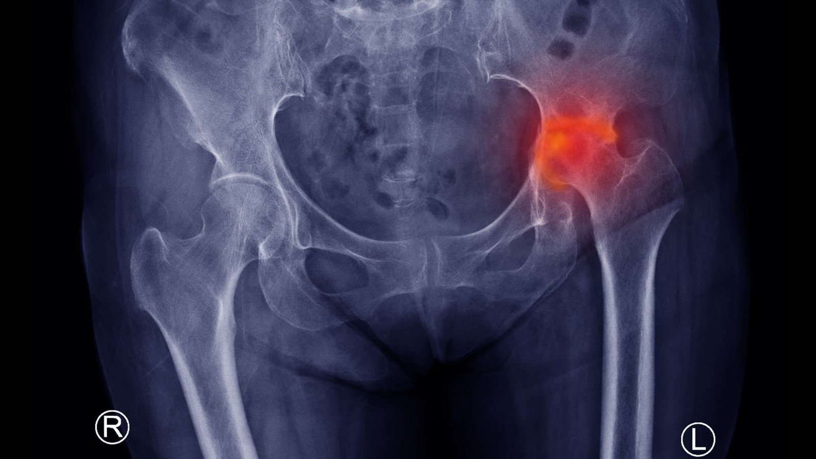 Avascular necrosis of hip