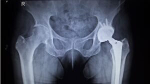 Direct anterior hip replacement