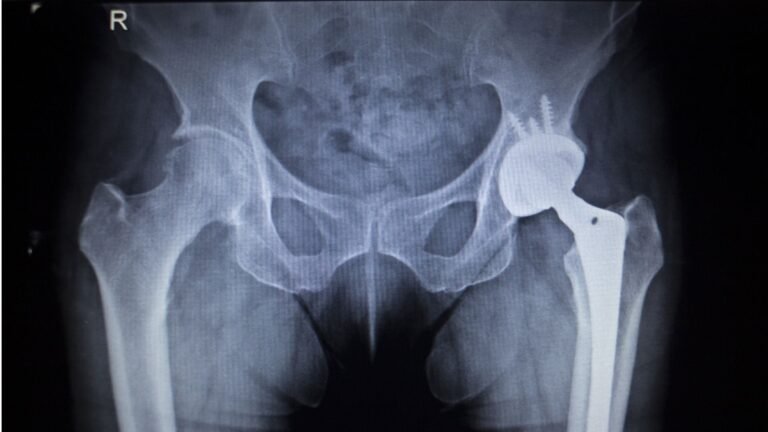 Direct anterior hip replacement
