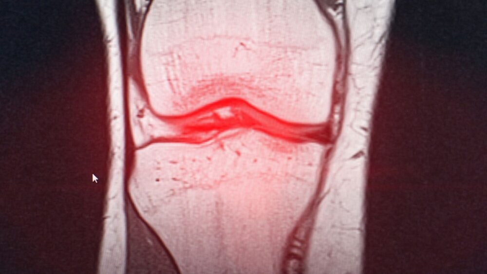 Knee meniscus injury